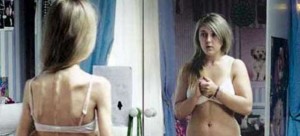 terapia_anorexia_bulimia